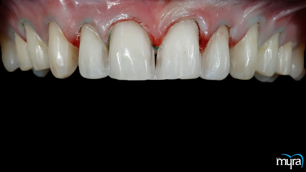 Myra Dental Centre - 7-benefits-of-dental-veneers