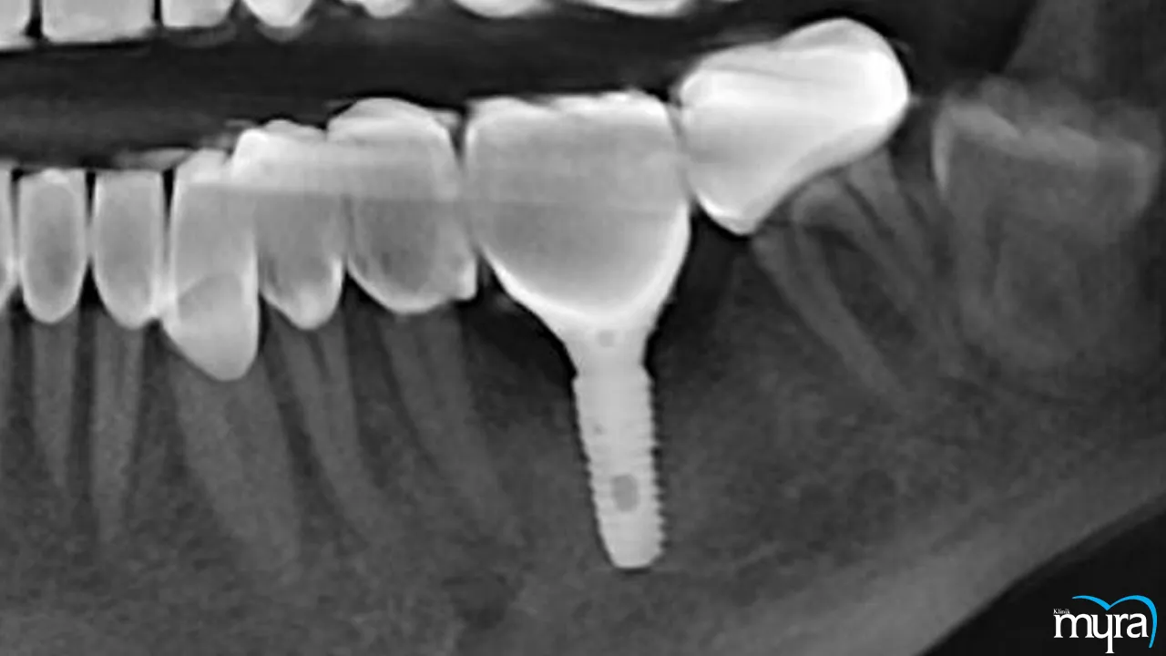 Dental implants