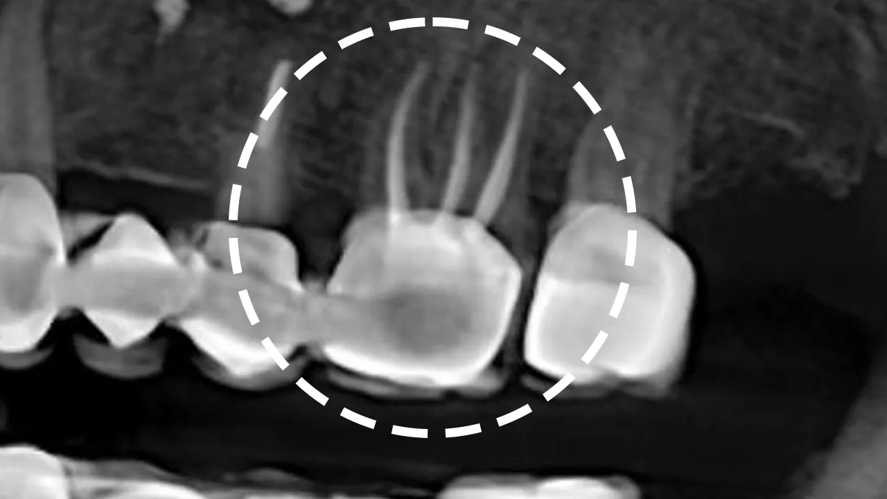 Dental Root Canal Treatments