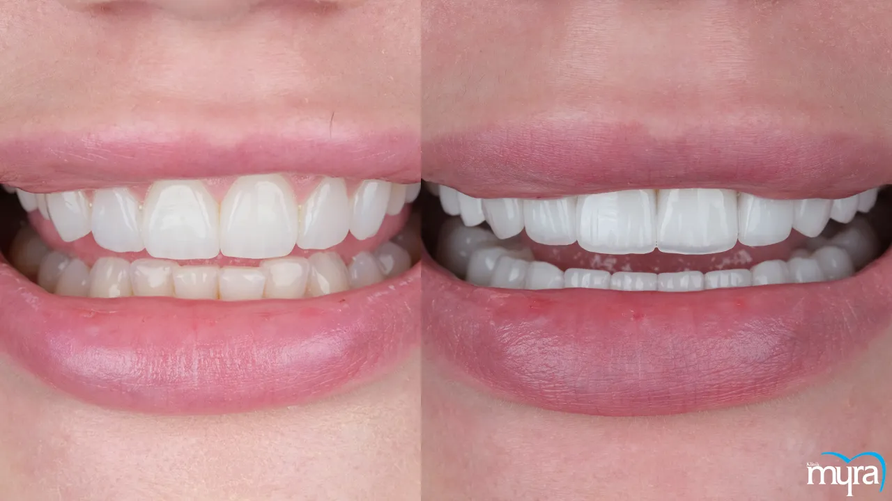 Dental veneers