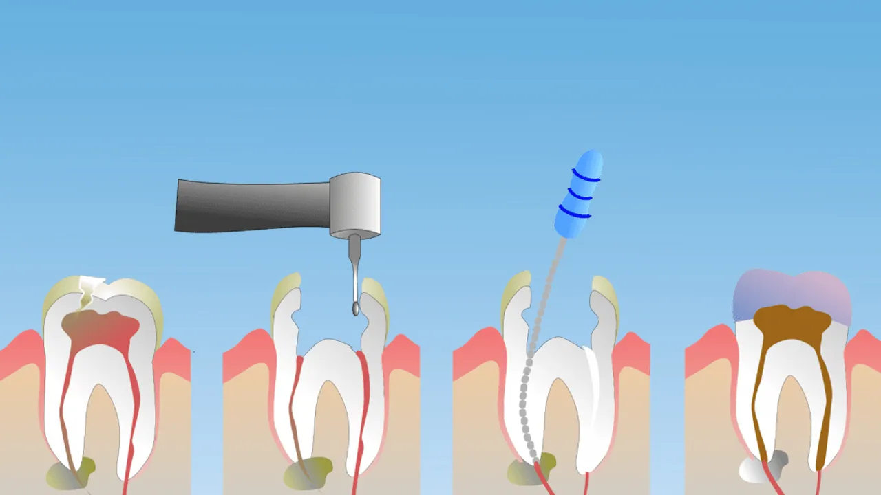 Myra Dental Centre Turkey - 9 Procedure for Dental Root Canal Treatments