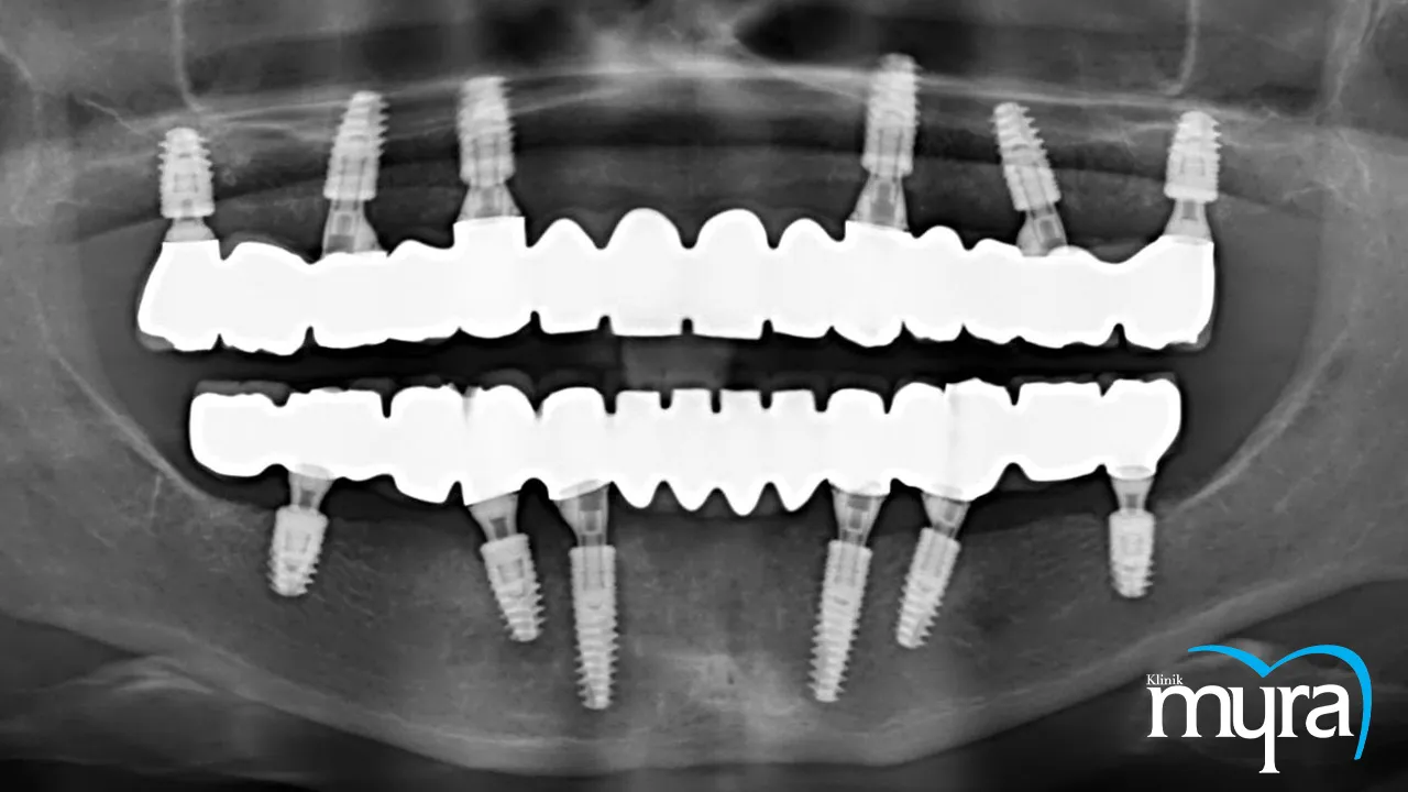 Cost of Dental Implant