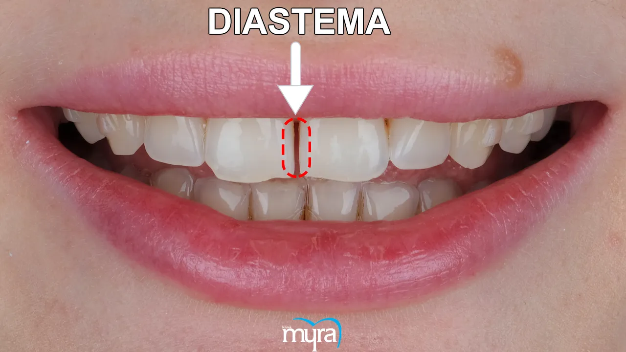 Principles of Smile Design