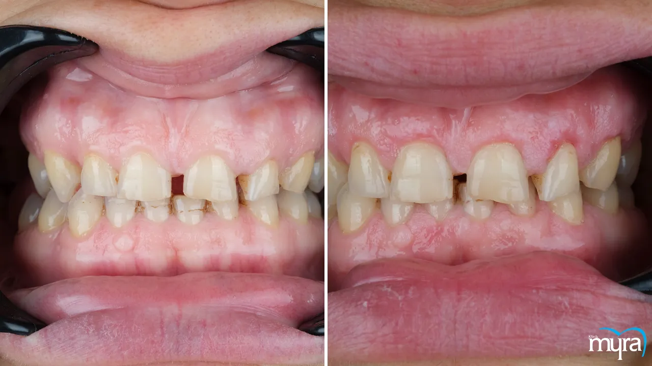 Myra Dental Centre - Gingival Esthetics Definition Different Procedures Advantages and Disadvantages