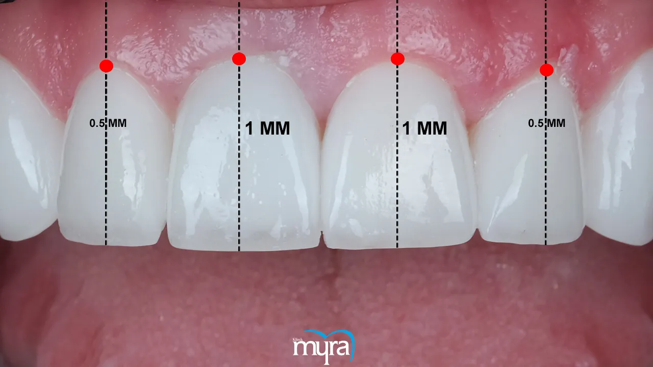 Principles of Smile Design