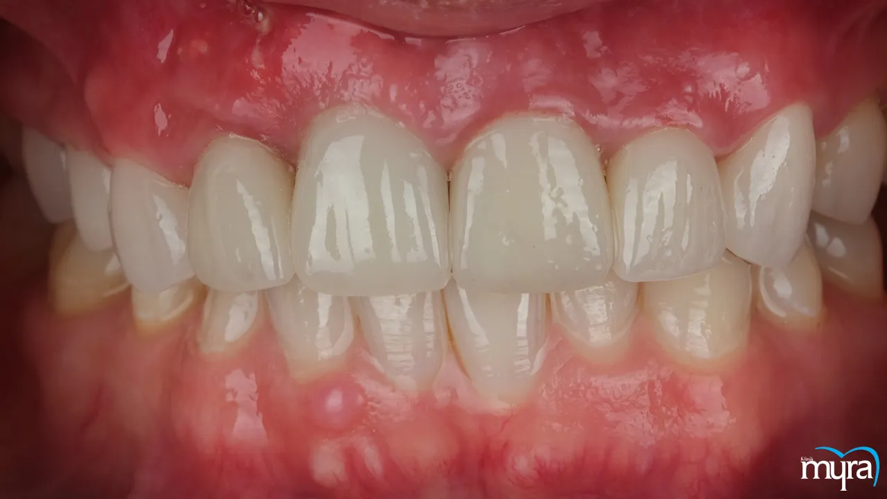 Gingival Esthetics