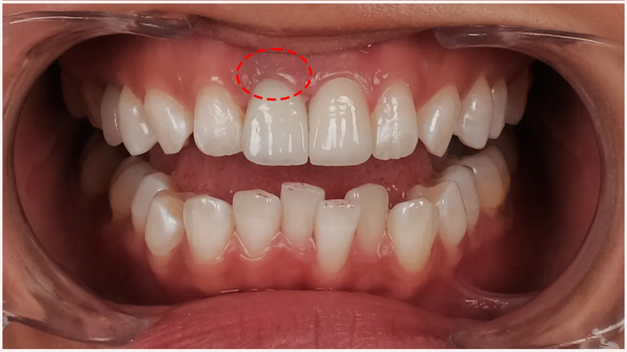 Myra Dental Centre - what-are-the-risks-of-dental-veneers