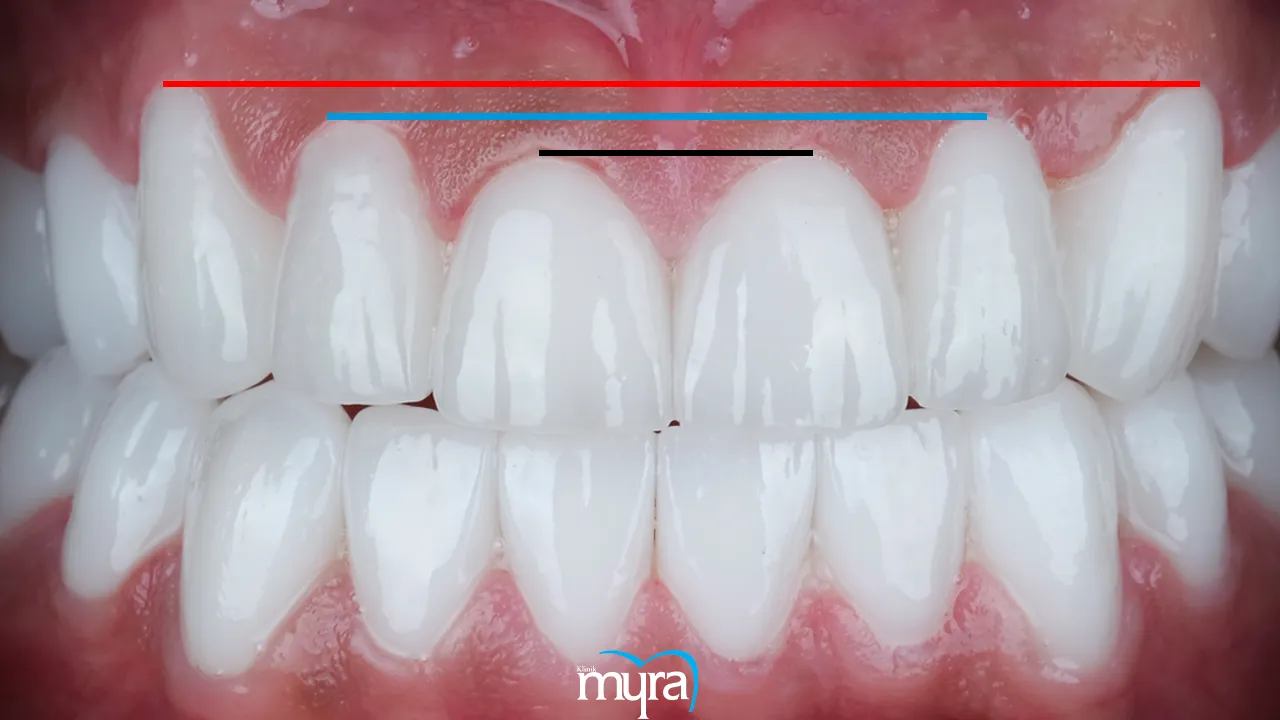 Principles of Smile Design