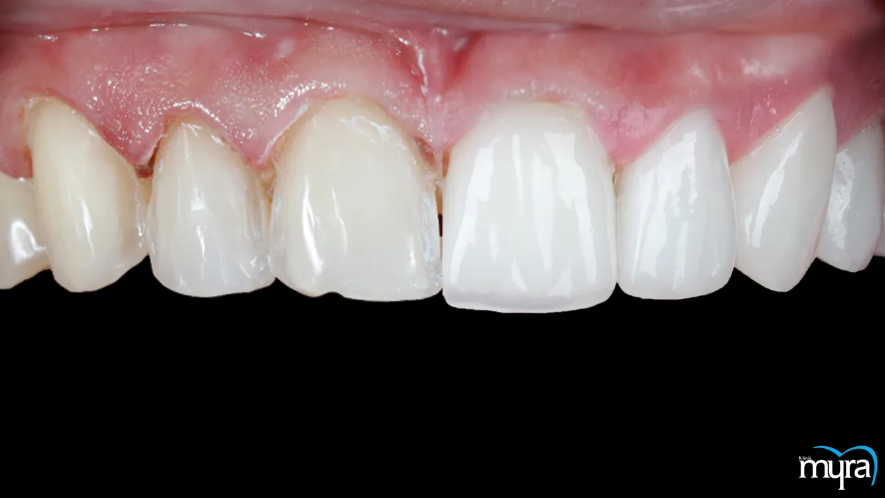 Myra Dental Centre - what-is-the-difference-between-dental-veneers-and-laminates