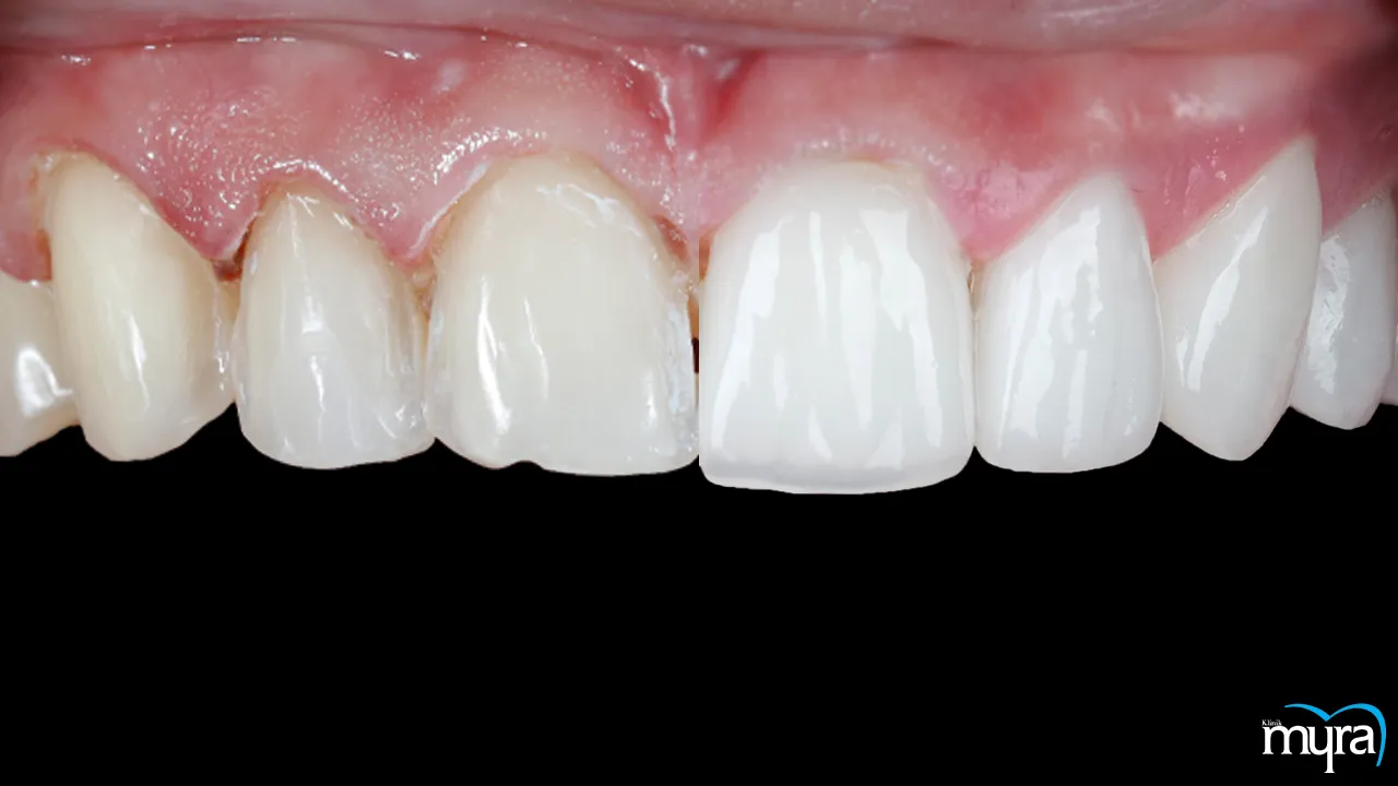 Dental Veneers vs Laminates