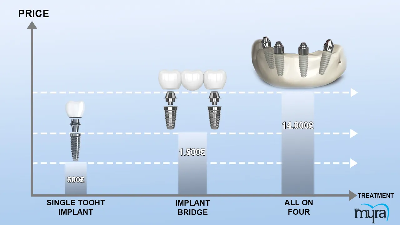 Myra Dental Centre - immediate-load-dental-implant-definition-benefits-and-cost