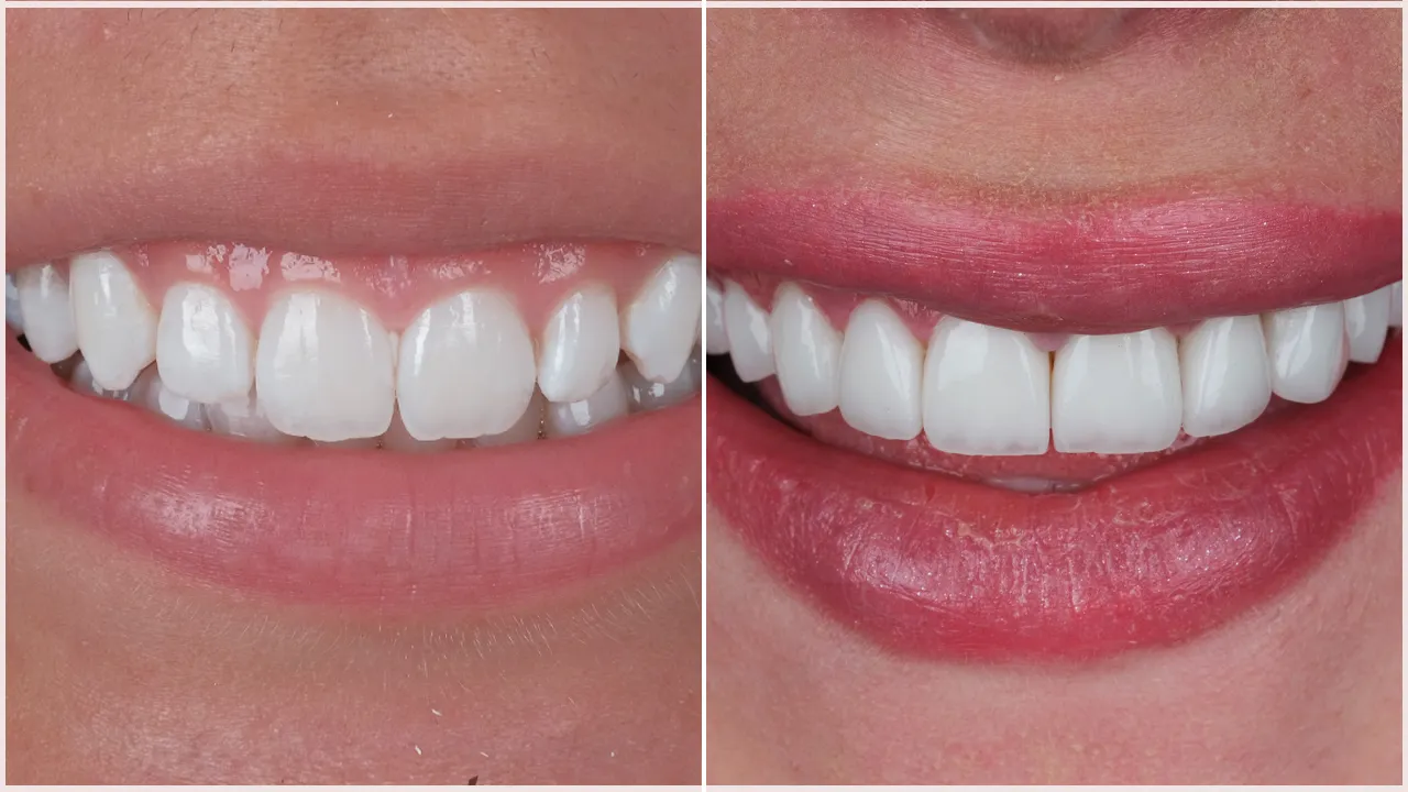 Teeth Whitening vs Laminates