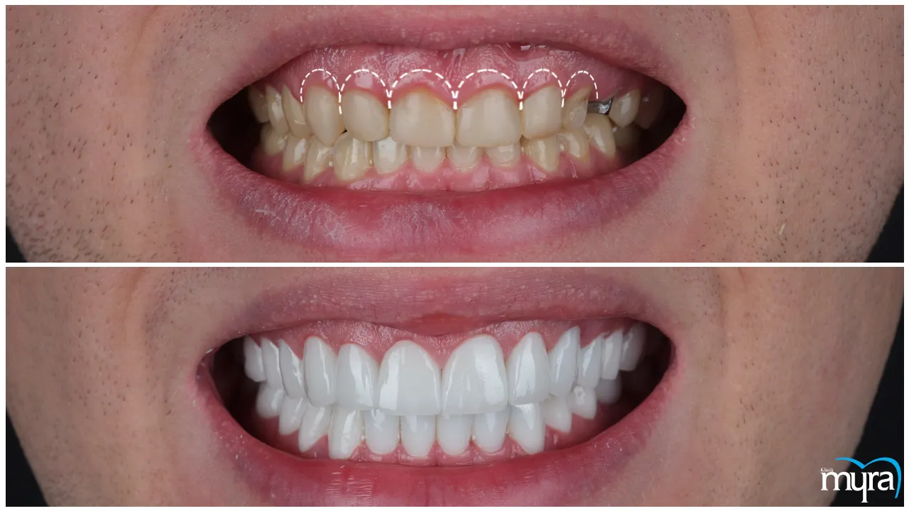 Gummy Smile Definition, Types, Benefits, and Cost- Myra Dental Centre Turkey