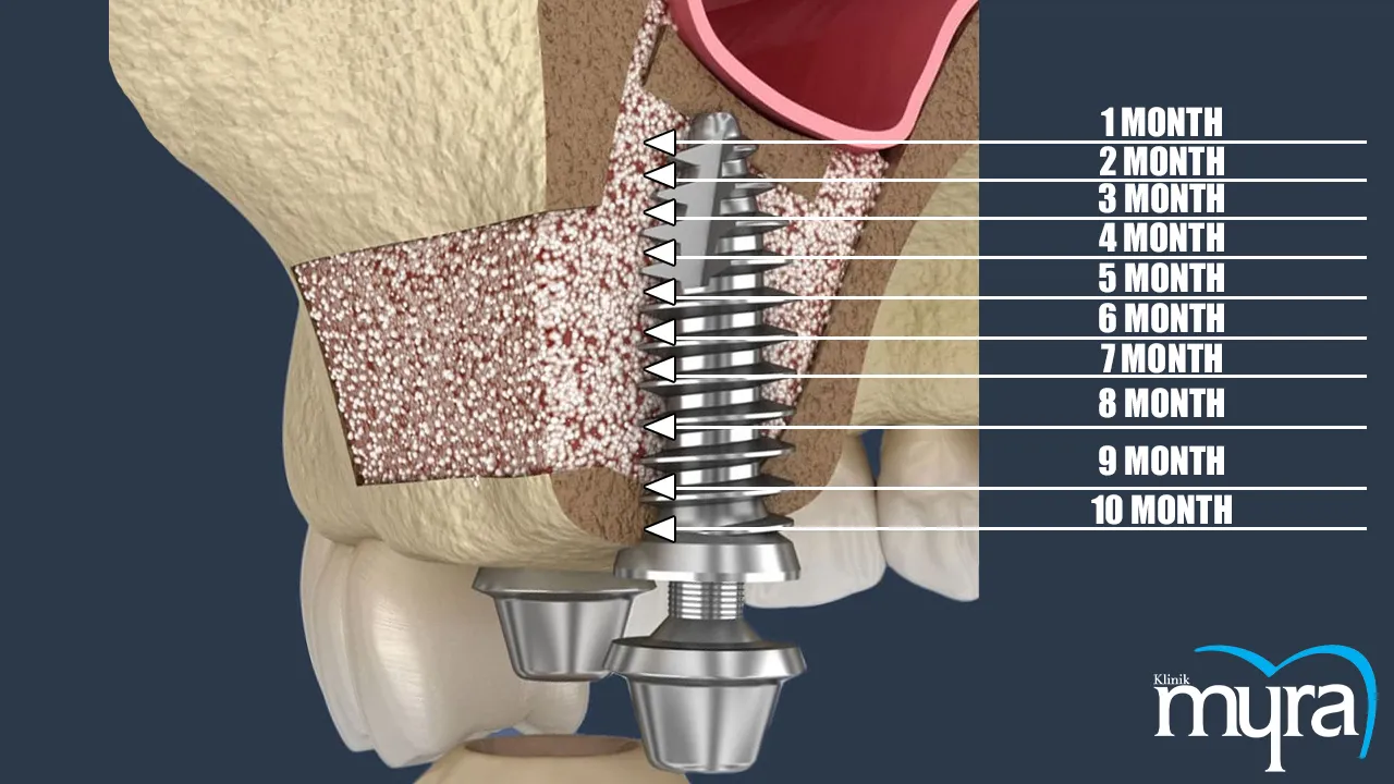 Sinus Lift Definition