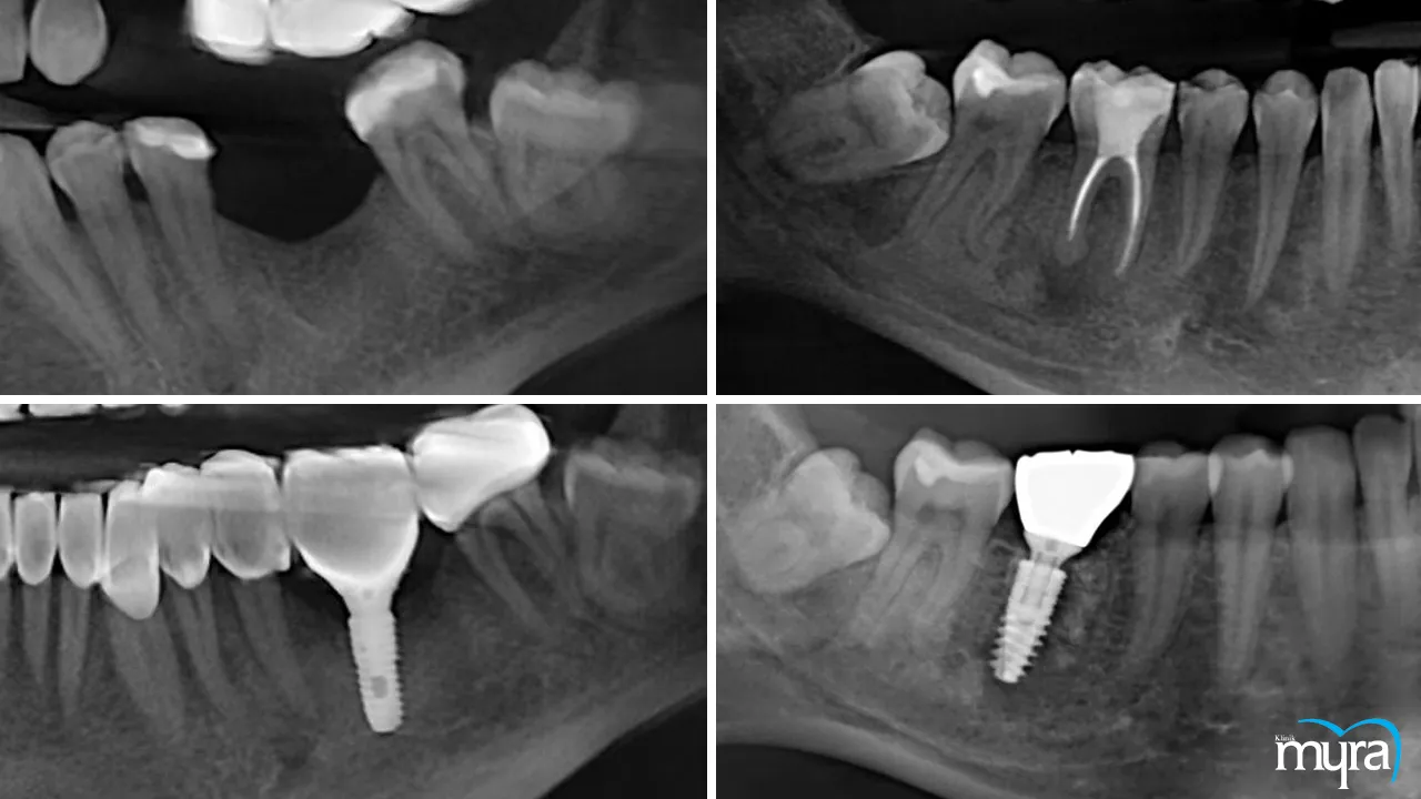 Immediate load dental implant Definition