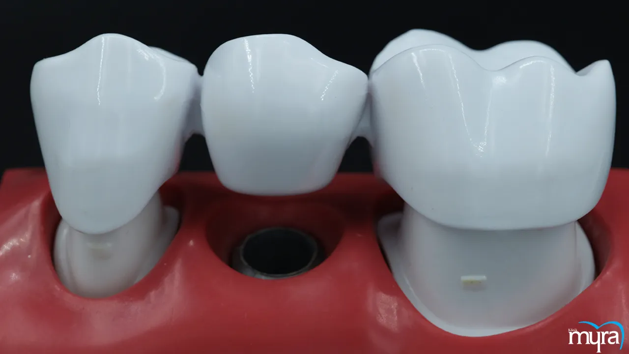 Myra Dental Centre Turkey-Dental-implants