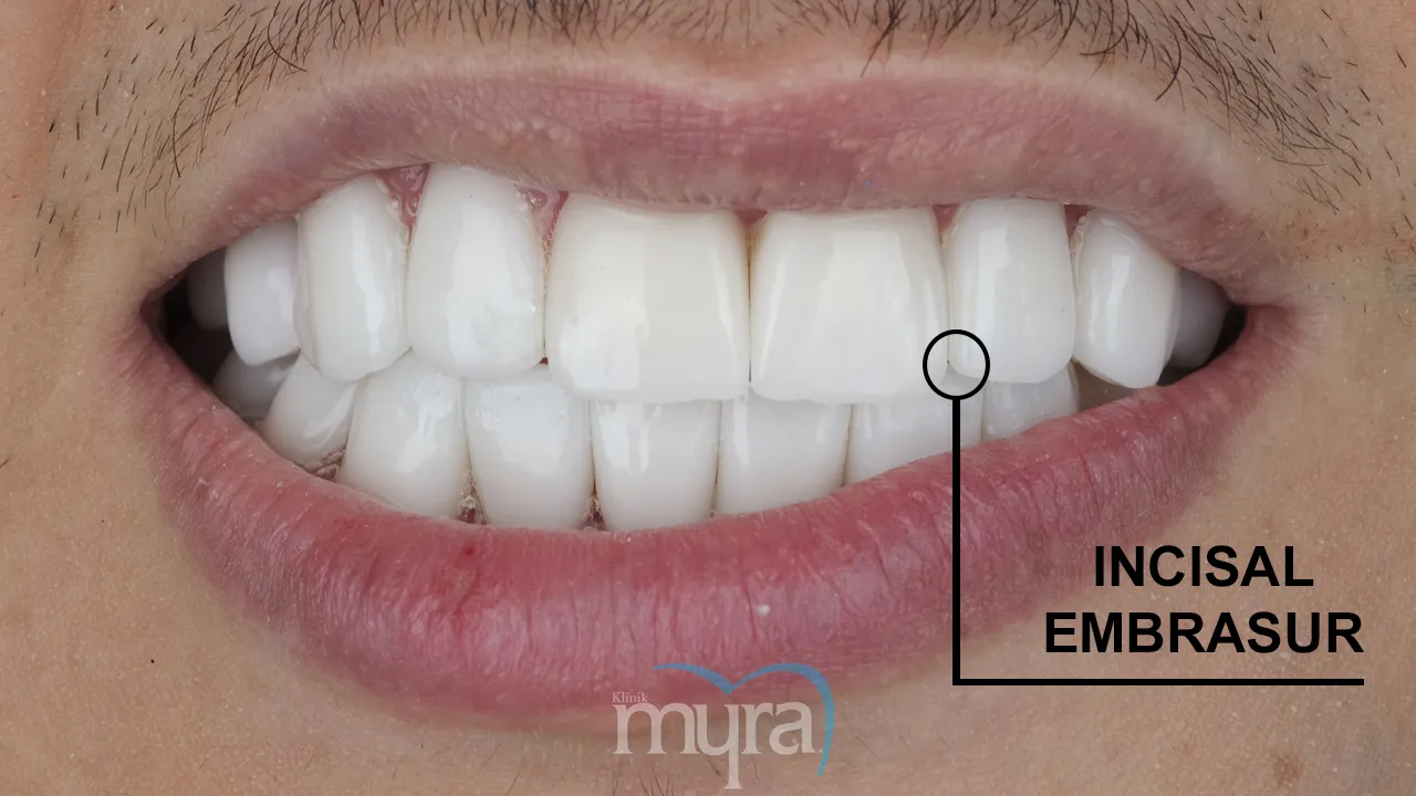 Principles of Smile Design