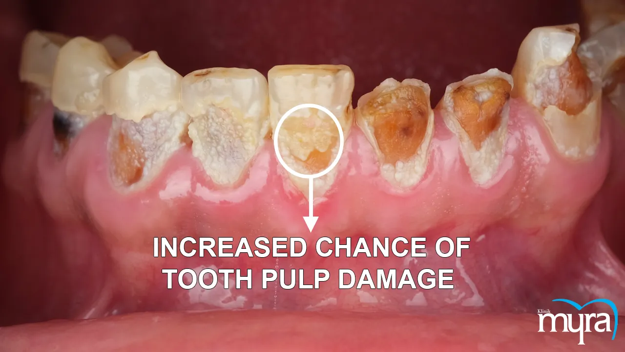 Myra Dental Centre - 5-side-effects-of-dental-veneer