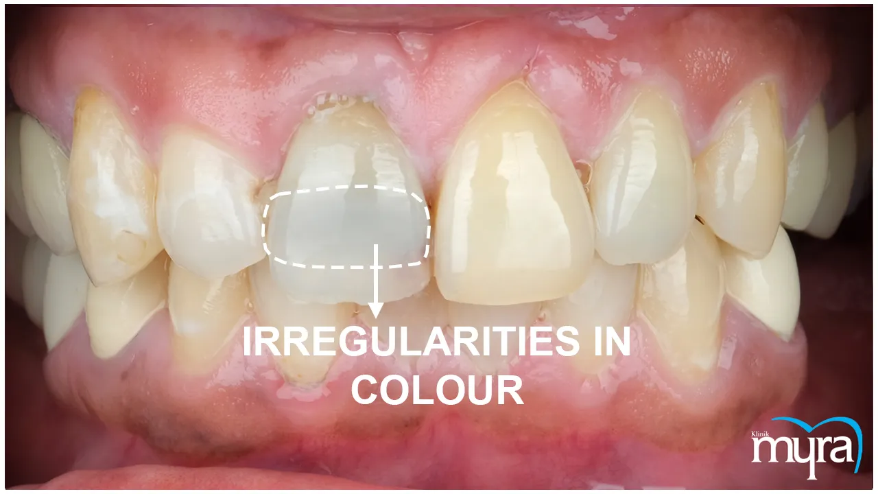 Side Effects of Dental Veneer