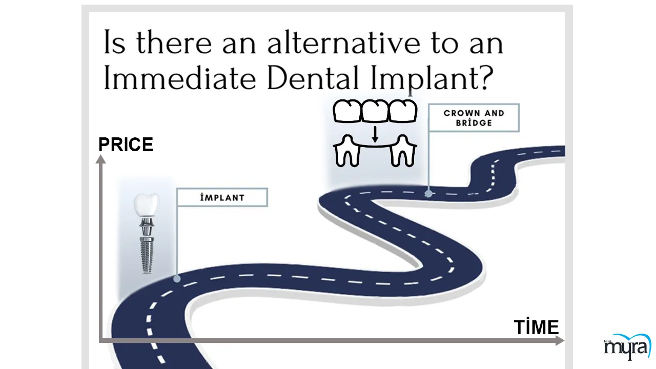 Immediate load dental implant Definition