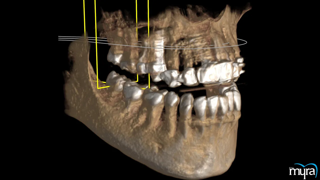 Key information about new teeth restoration with implants in Turkey