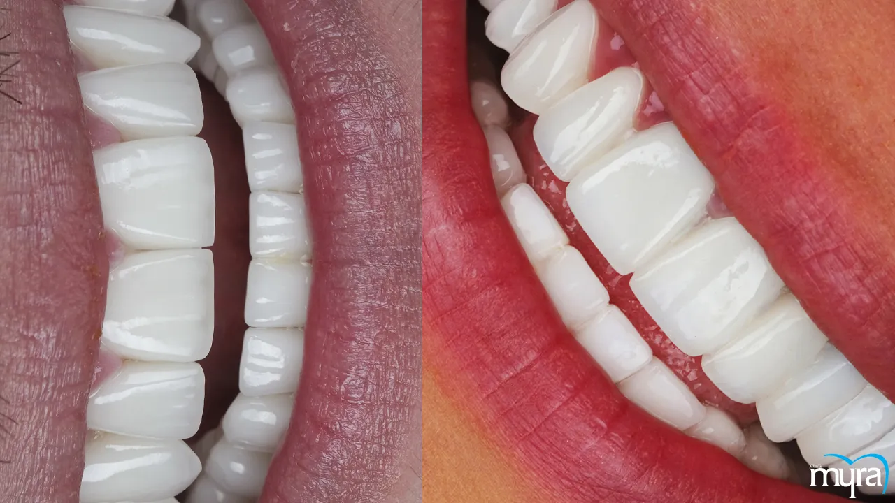 Dental veneers