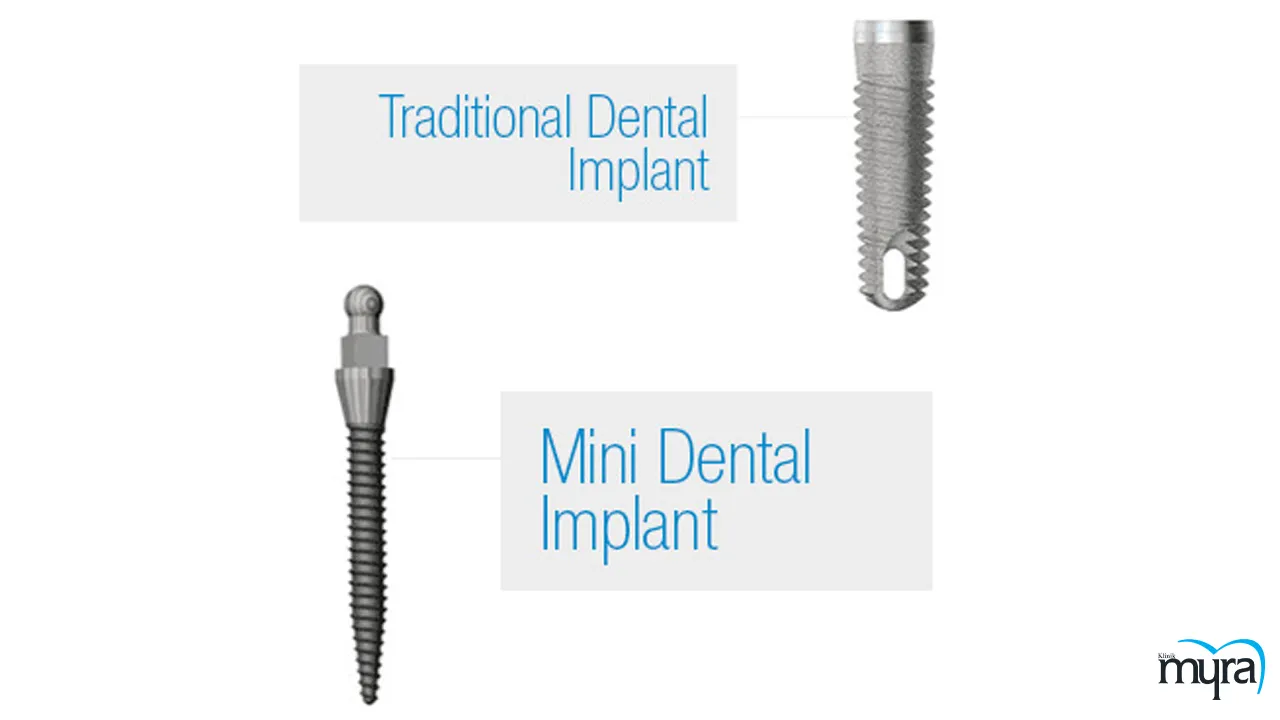 Myra Dental Centre Turkey- Finding-the-most-affordable-tooth-implant-options