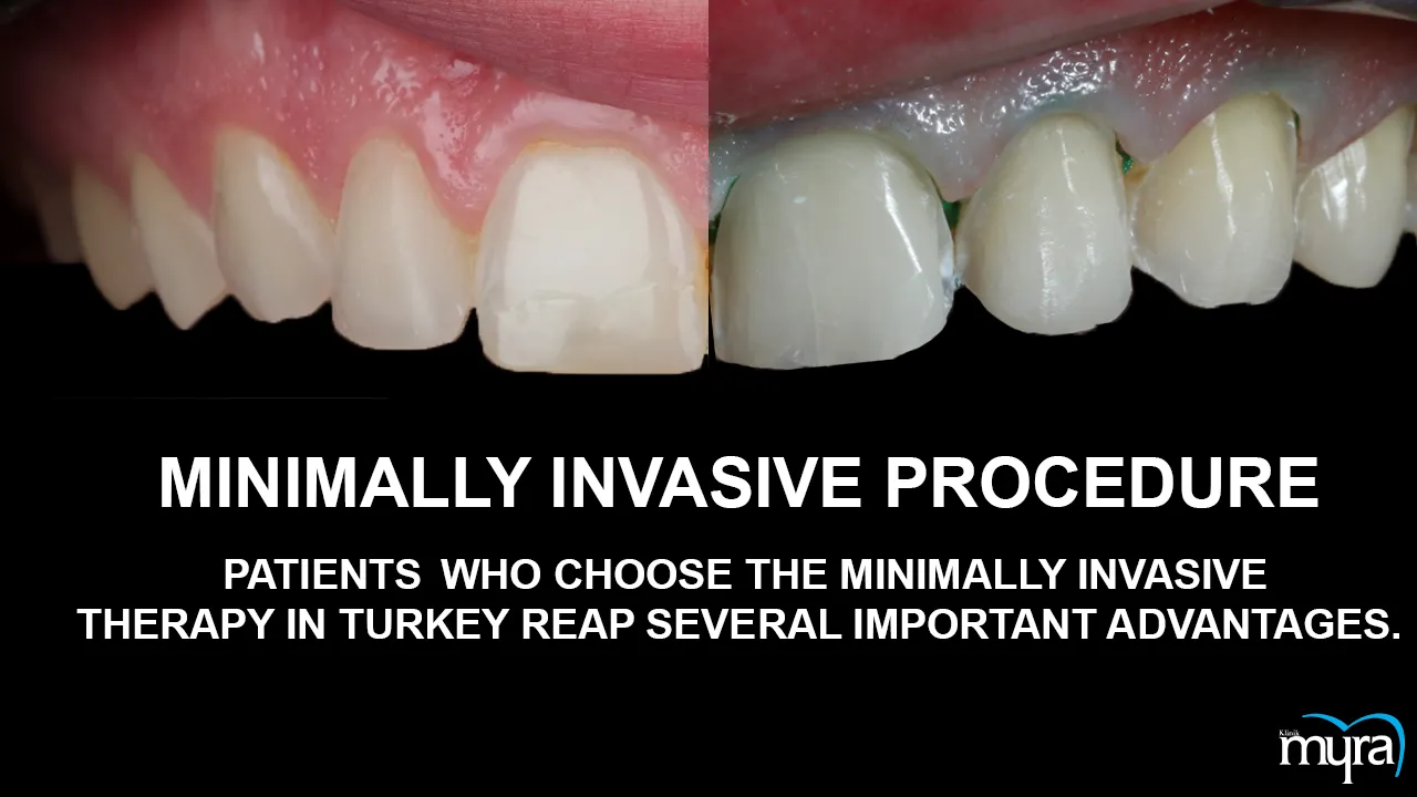 Myra Dental Centre Turkey - Benefits of obtaining a full set of veneers in Turkey