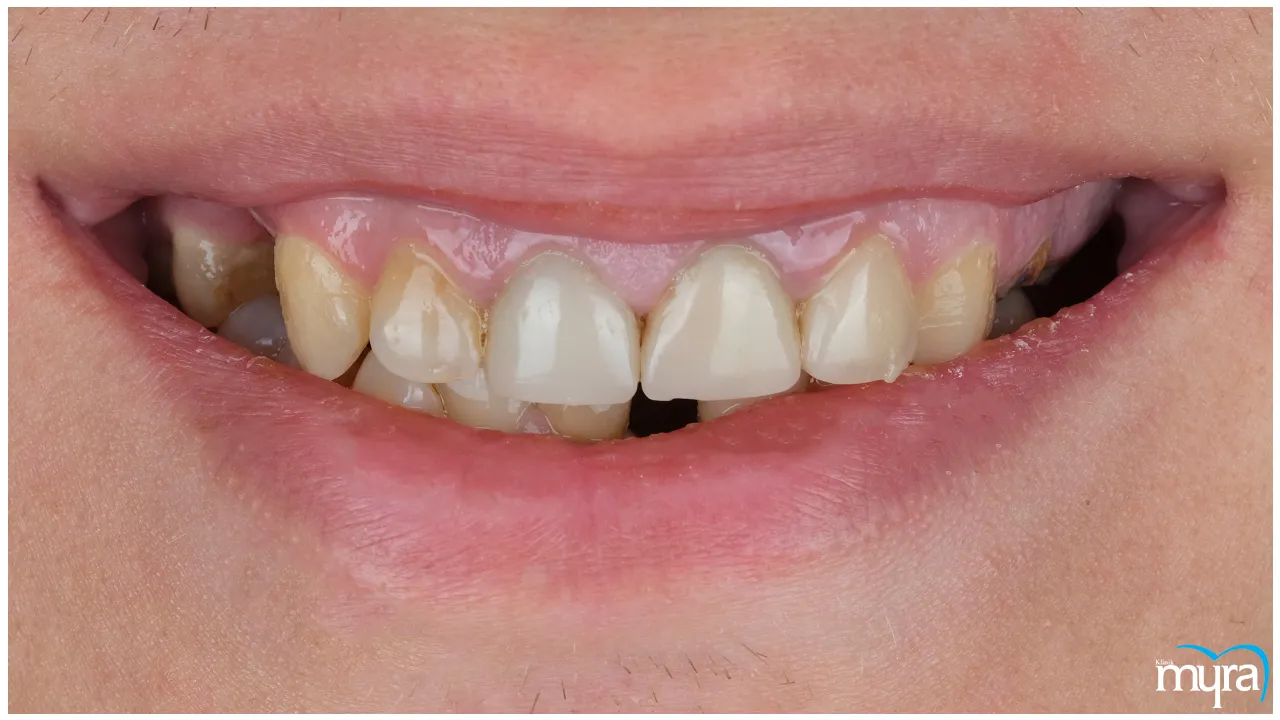 Gummy Smile Definition, Types, Benefits, and Cost- Myra Dental Centre Turkey