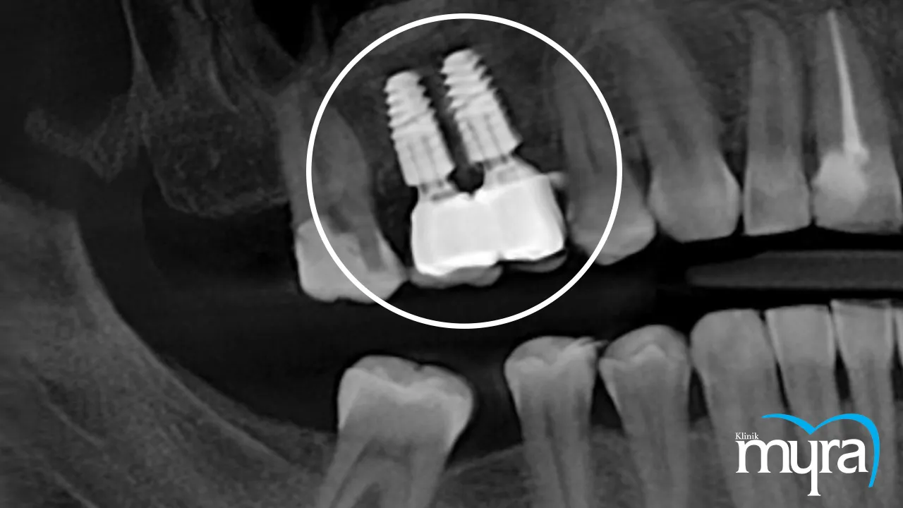 Cost of Dental Implant