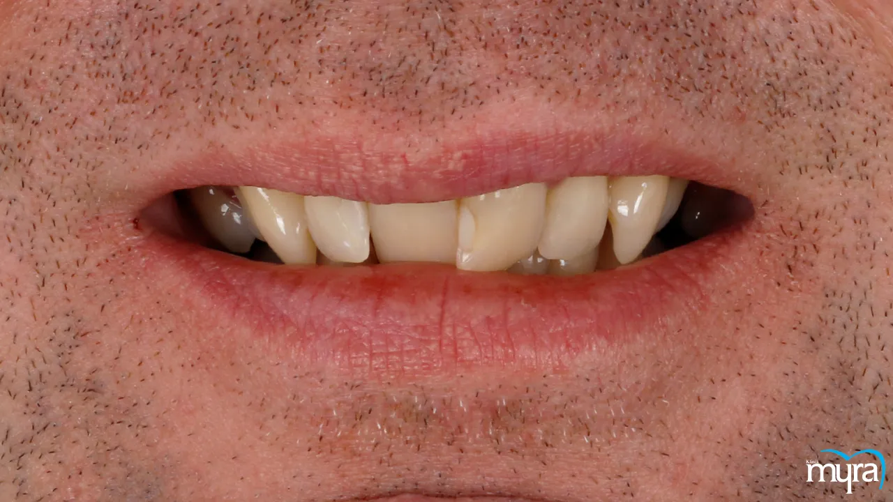 Myra Dental Centre Turkey - Narrow-smile 