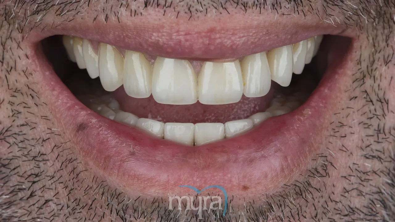 Myra Dental Centre Turkey - Veneer Stains Causes and Prevention
