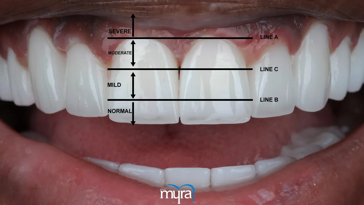 Principles of Smile Design