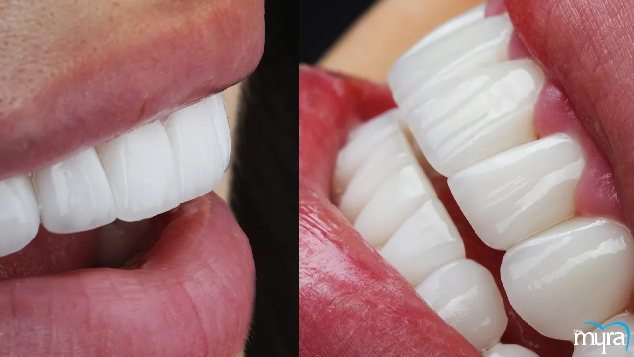 Dental veneers