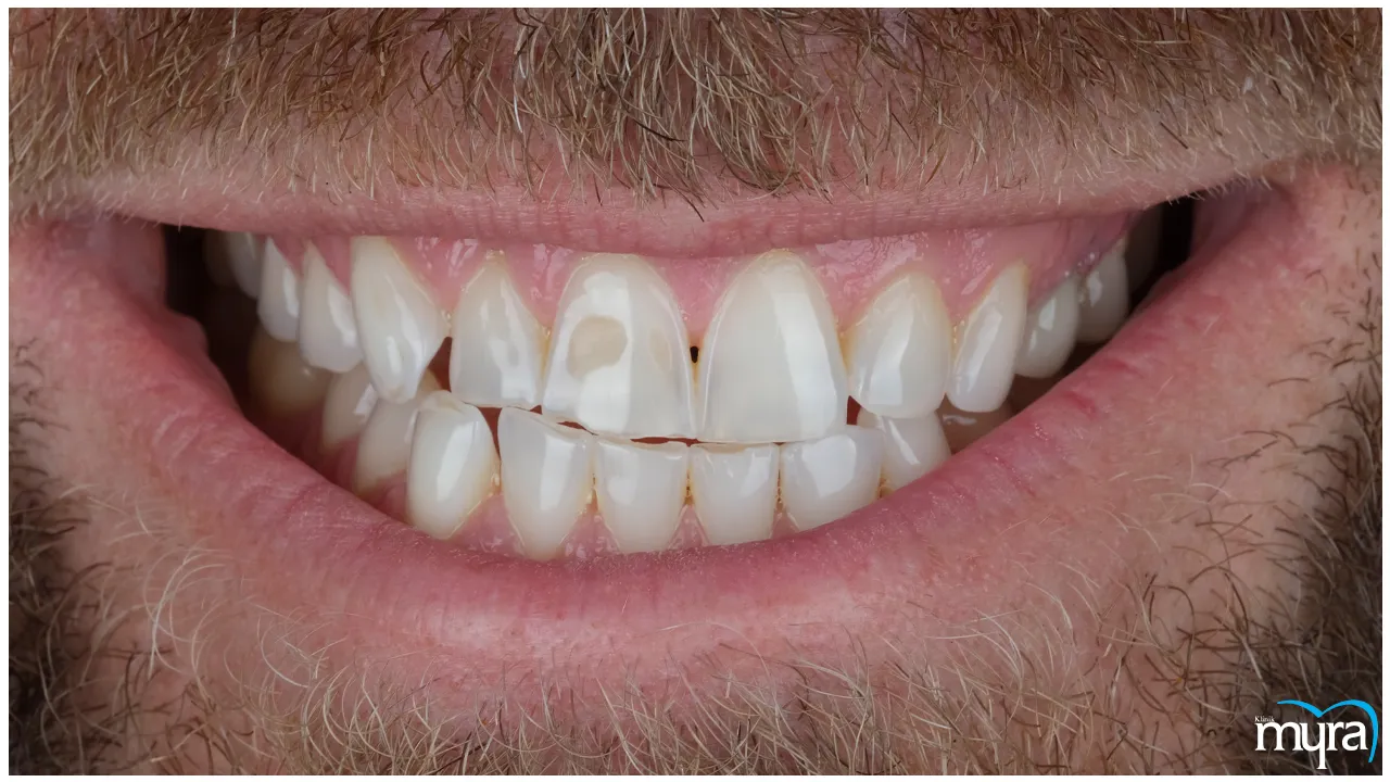  Gummy Smile Definition, Types, Benefits, and Cost- Myra Dental Centre Turkey