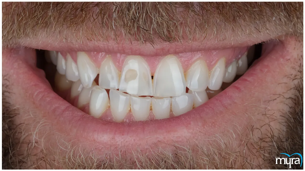 Gummy Smile Definition, Types, Benefits, and Cost- Myra Dental Centre Turkey