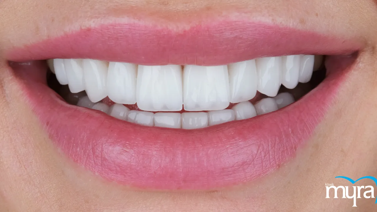 Myra Dental Centre - 5-side-effects-of-dental-veneer