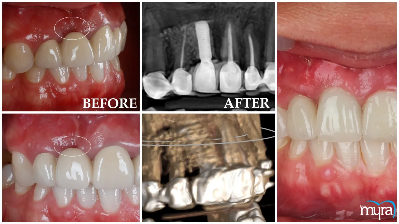 Single Tooth Implant Definition