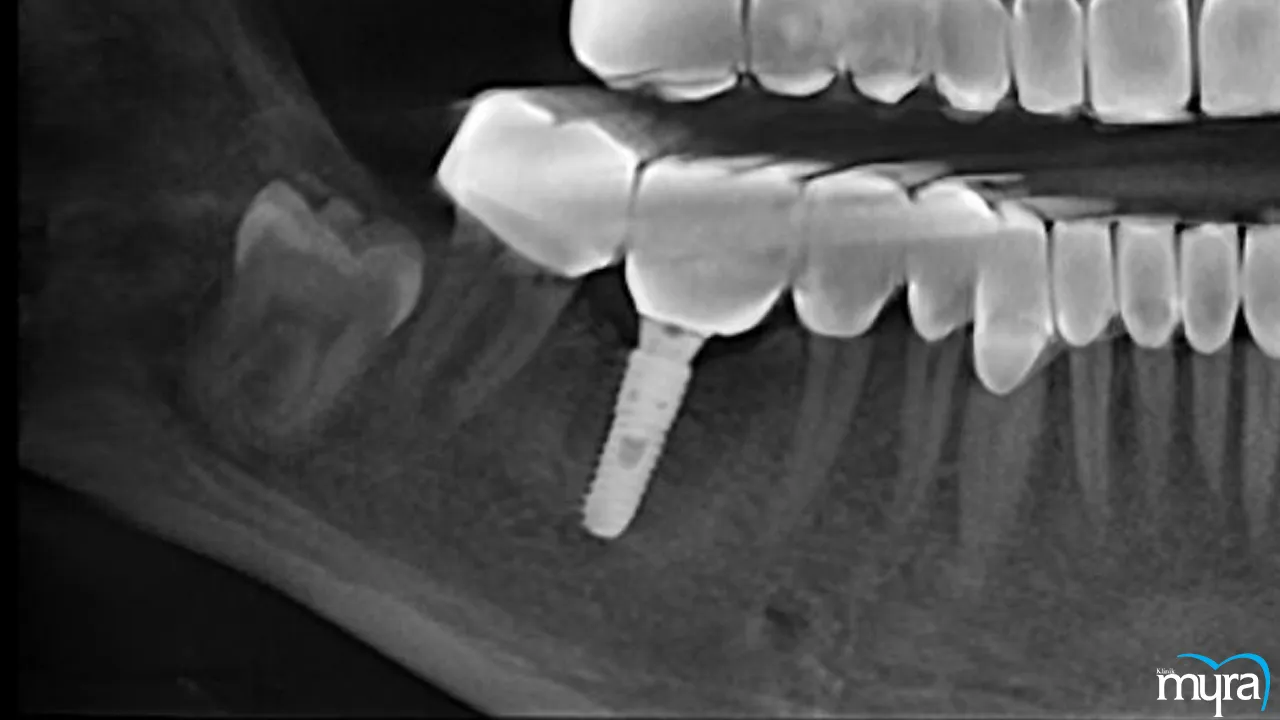 Cost of Dental Implant