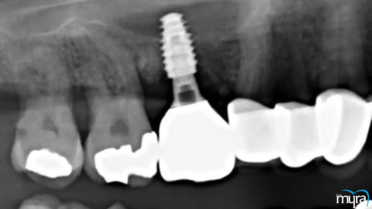 Dental implants