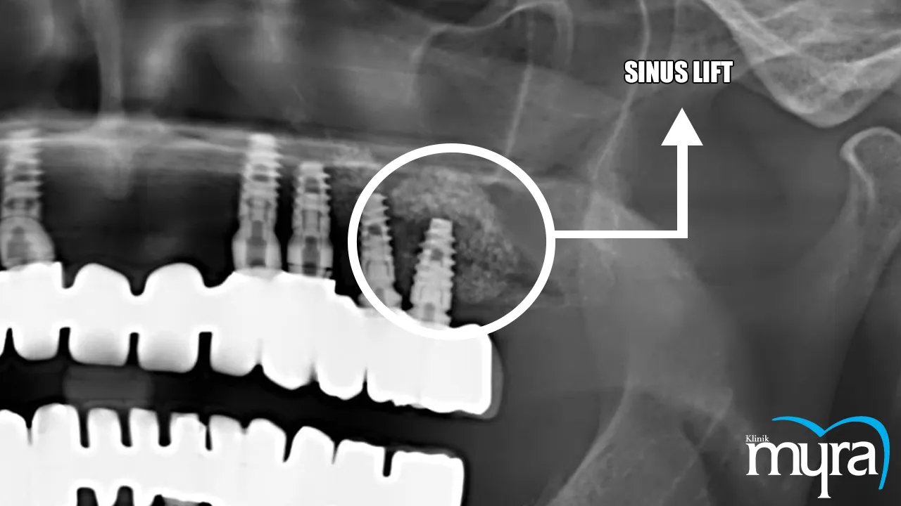 8-dental-implant-surgery-techniques-Myra Dental Centre Turkey