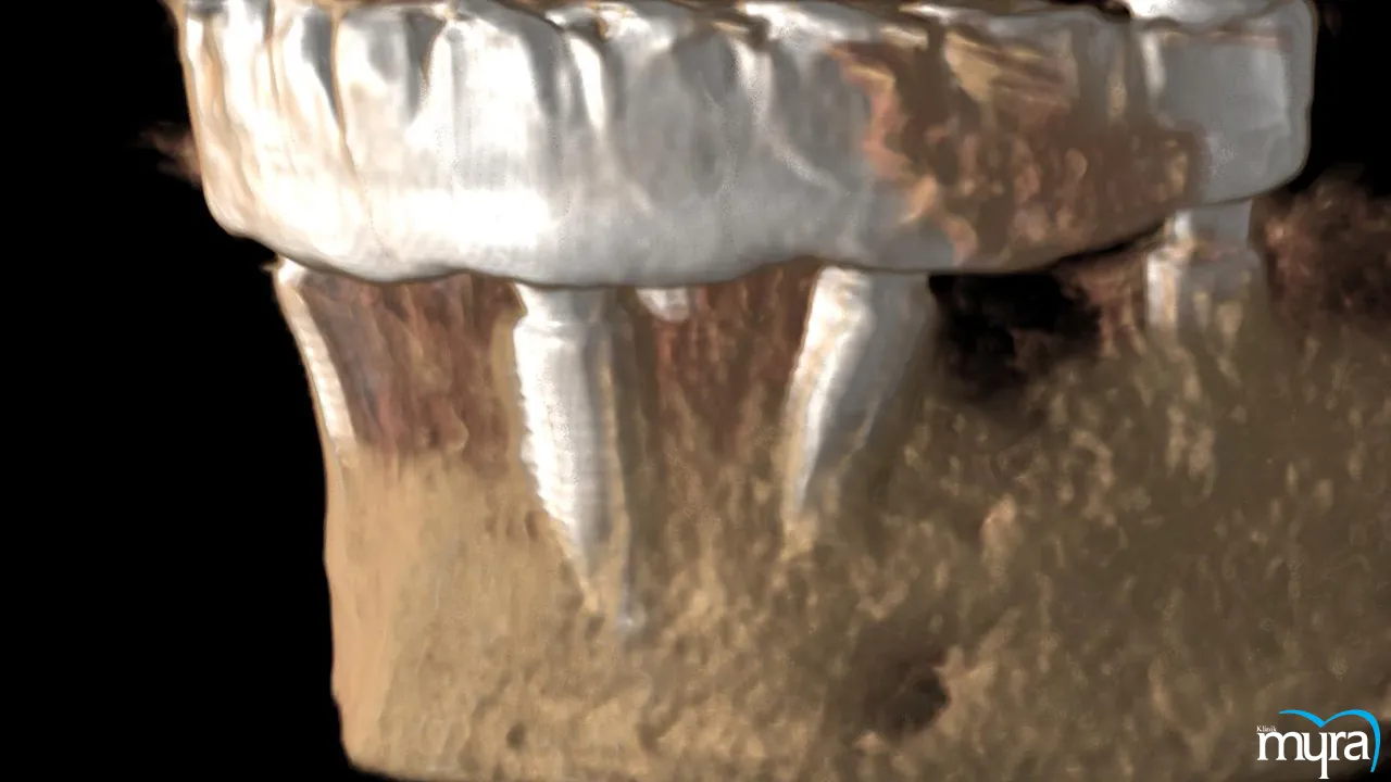 Dental implants