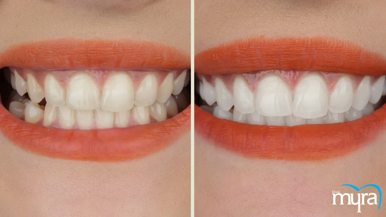 Myra Dental Centre - smile-design-definition-theories-and-procedures