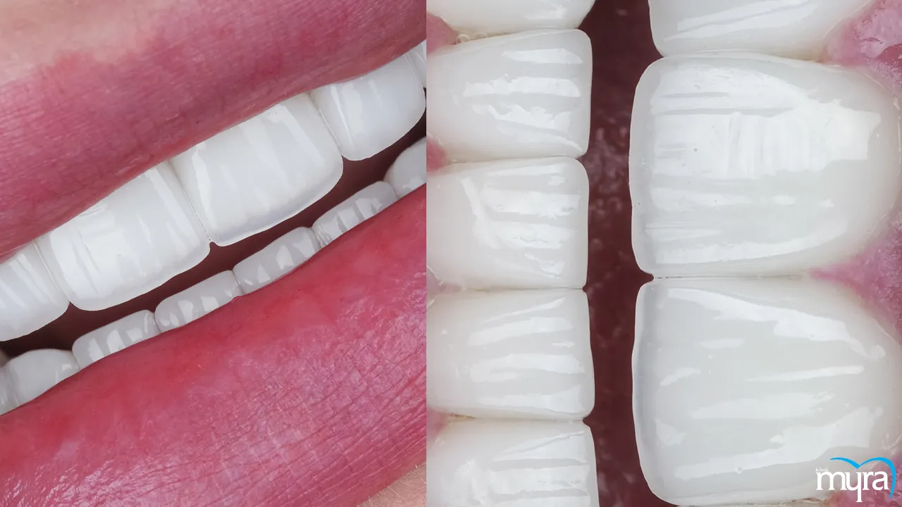 Dental veneers