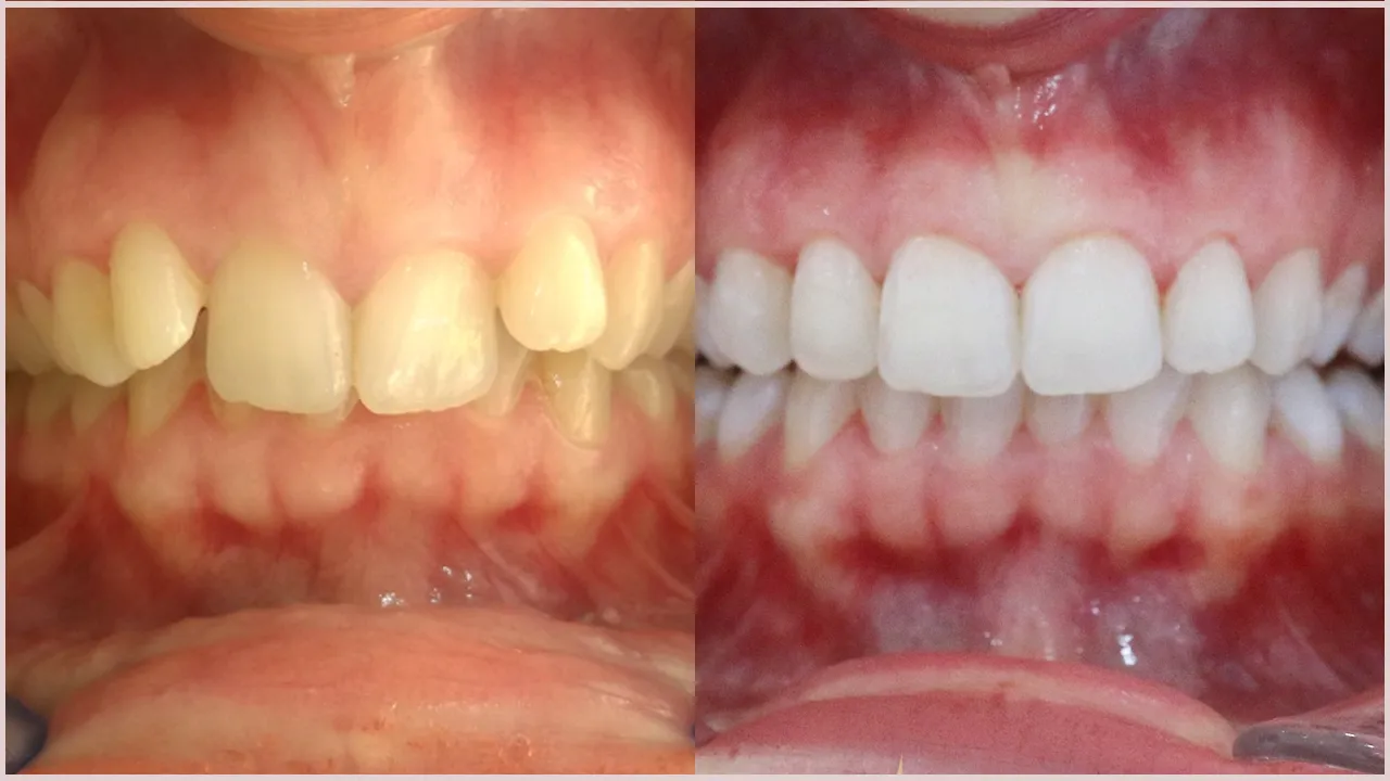 How Do I Address Uneven Whitening Results?