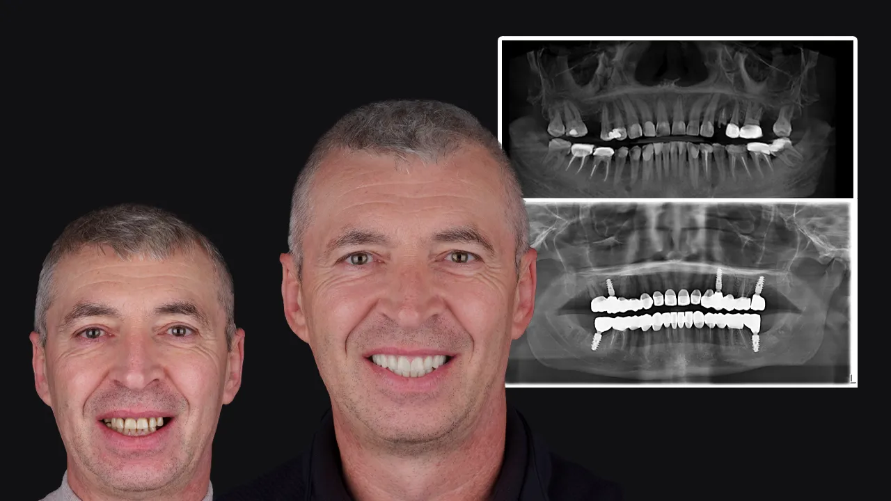 13 Essential Facts to Know Before Getting Dental Implants Abroad