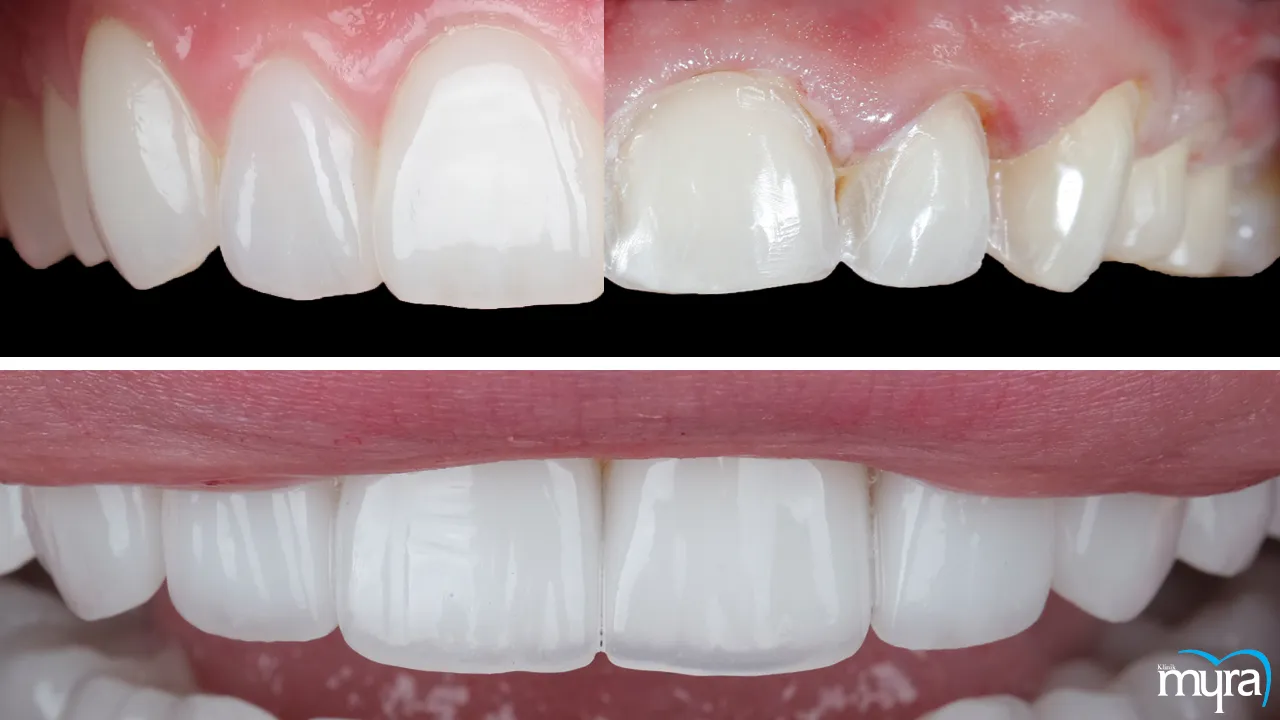 Dental veneers