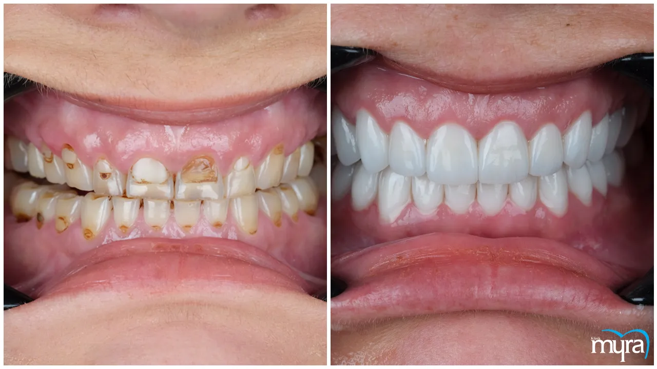  Things to Avoid After Dental Implants - Myra Dental Centre Turkey