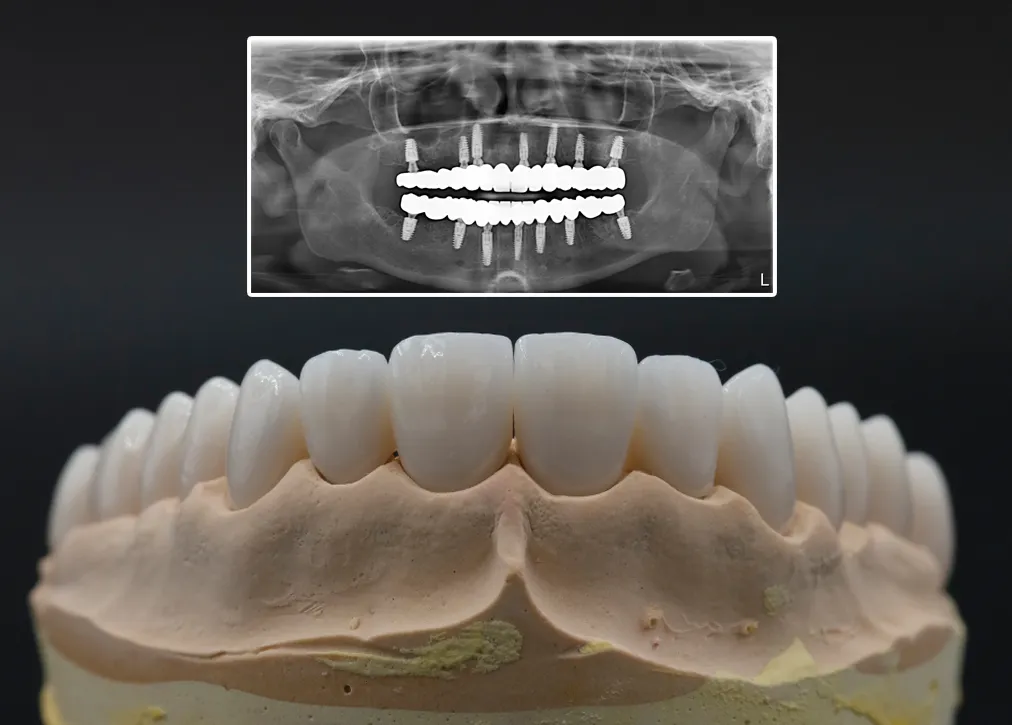 All-on-4 Dental Implants in Turkey: Cost, Pros, and Cons at Myra Dental Centre