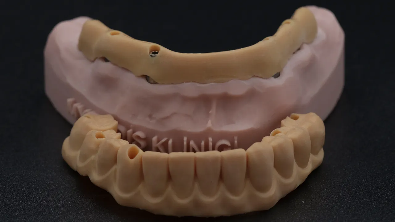 Crowns vs Bridges: Difference Between Dental Crowns and Dental Bridges